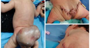 استئصال ورم عجزي من طفلة عمرها يومين بالفيوم-وكالة لحظة الإخبارية