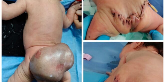 استئصال ورم عجزي من طفلة عمرها يومين بالفيوم-وكالة لحظة الإخبارية